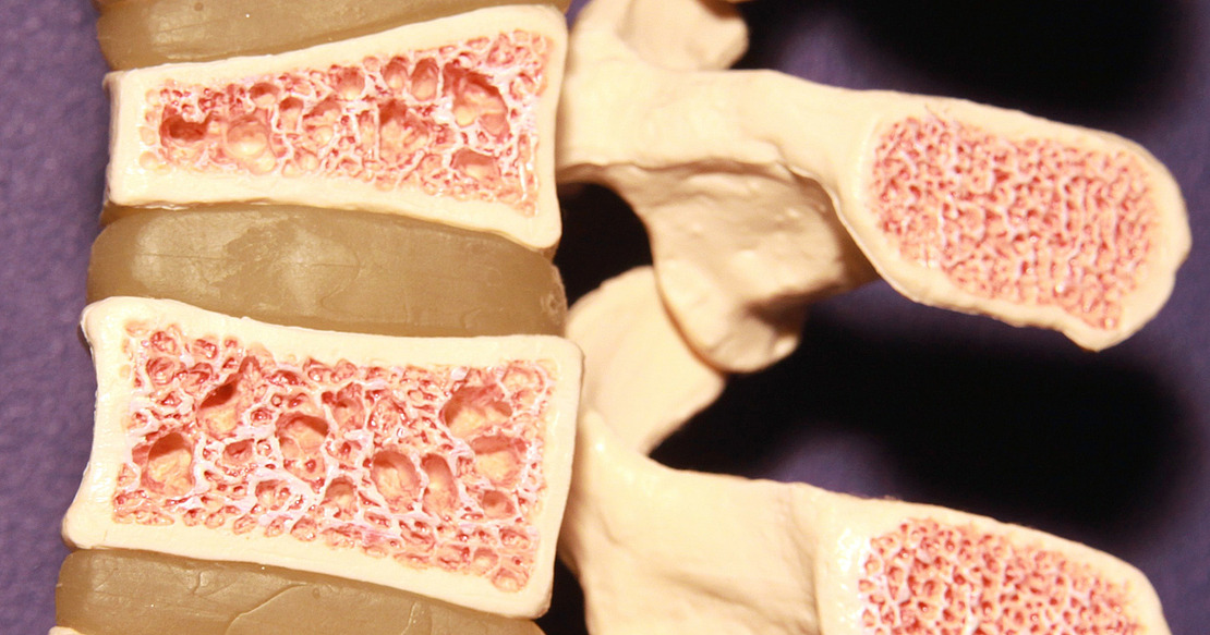 Knochenmodell mit Osteoporose