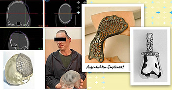 Implantate für Verwundete © Ukraine-Hilfe Berlin e.V. Bilder von Implantaten für Verwundete